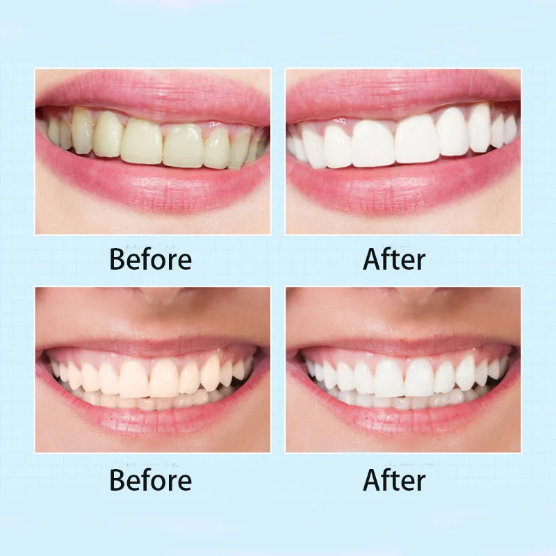

Teeth Whitening Pen Oral Hygiene Care Cleaning Serum Remove Plaque Stains Dental Bleach Tools Whiten Tooth Whitening Instrument