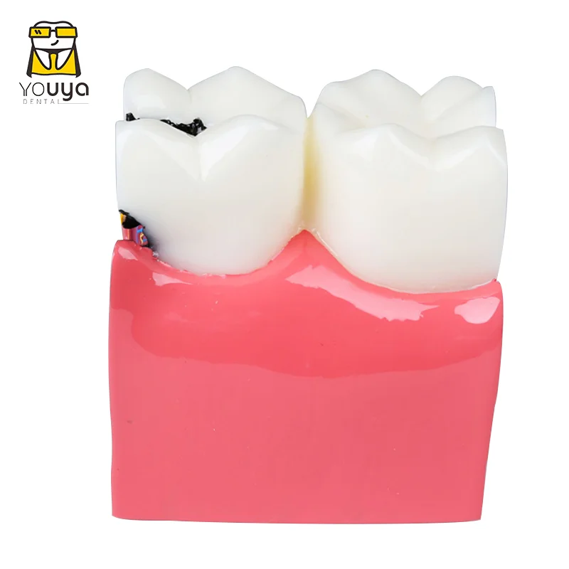 

6 Times Dental Model Molar Pathological Anatomic Comparison Model To Facilitate The Study Of Tooth Structure And Lesion Process