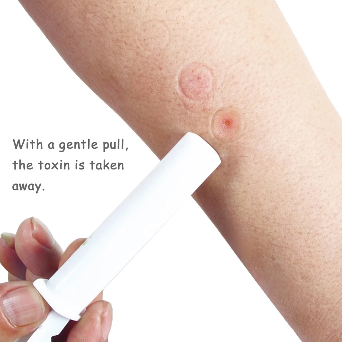 

New Mosquito Bite Venom Poison Extractor Swelling/Itching Reducing First Aid Vacuum Pump Anti-mosquito Tools for Camping