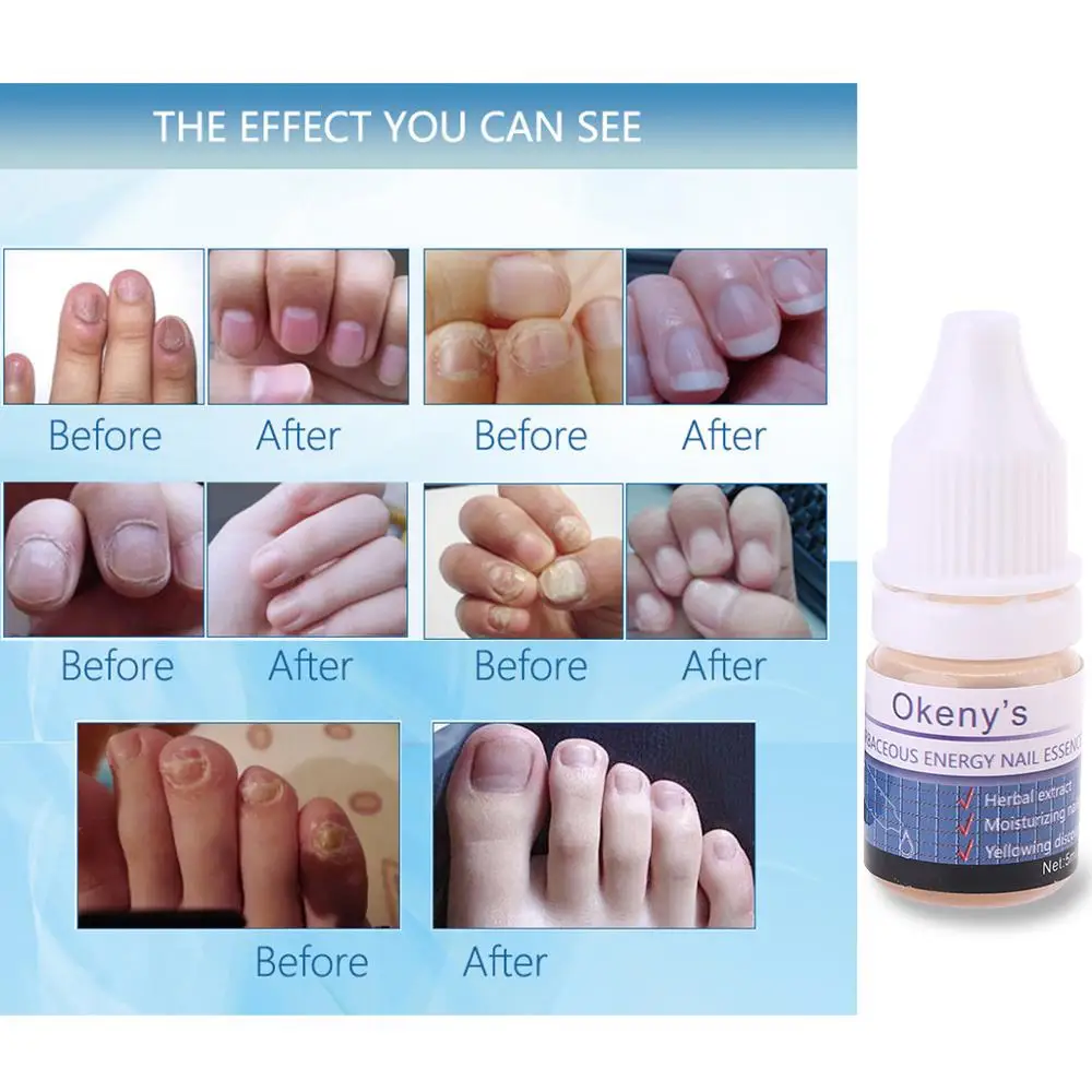 5 мл грибковое удаление пальцев ног Лечение ногтей гелевая эссенция яркий