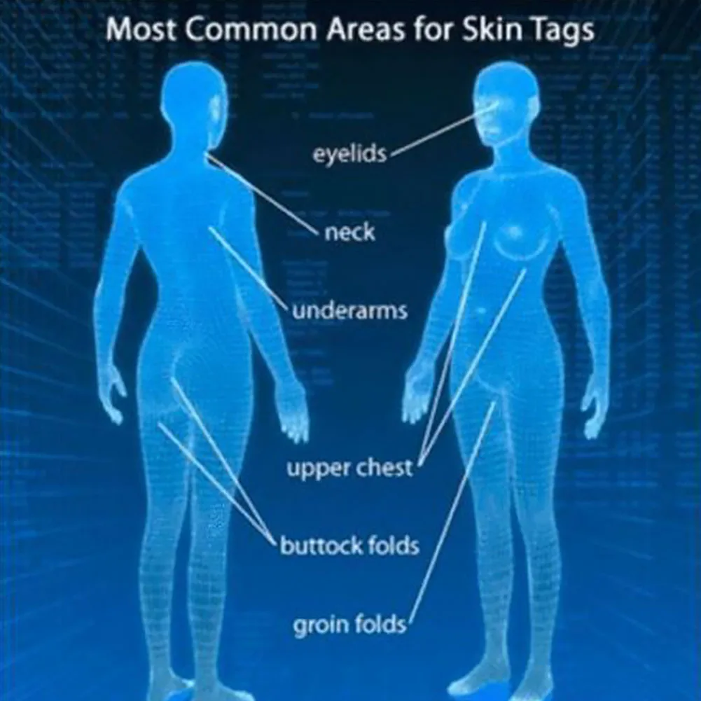 Body Skin Care Medical Tag Kill Mole Wart Remover Effective 10ml | Красота и здоровье