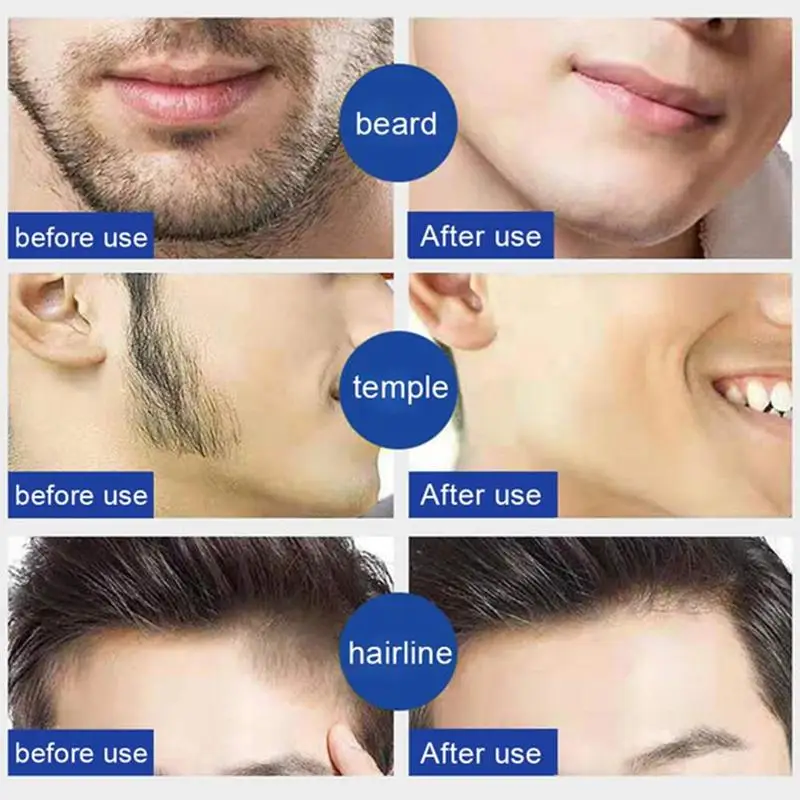 

Beard And Beard Hair Removal Cream For Men's Beard And Beard