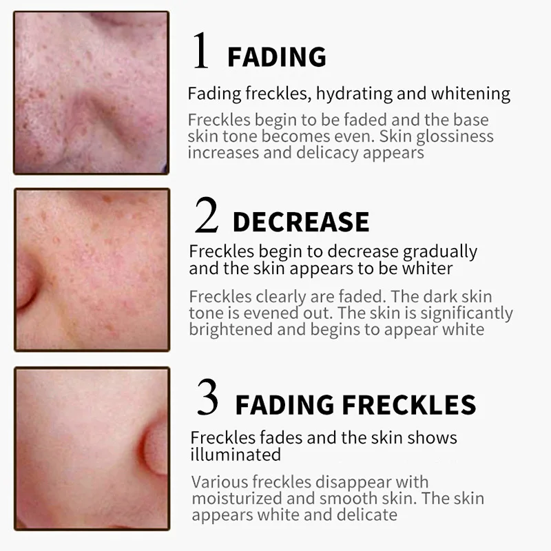 

Powerful Whitening Freckle Cream Remove Melasma Acne Spot Pigment Melanin Dark Spots Pigmentation Moisturizing Gel Skin Care