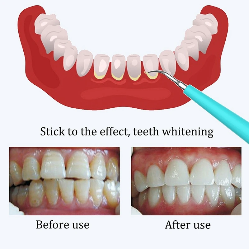 

Hot TOD-New Oral Teeth Whitening Clean Home Use Teeth Stains Scaling Tool Teeth Stain Remover Tartar Scaler Cleansing Mac