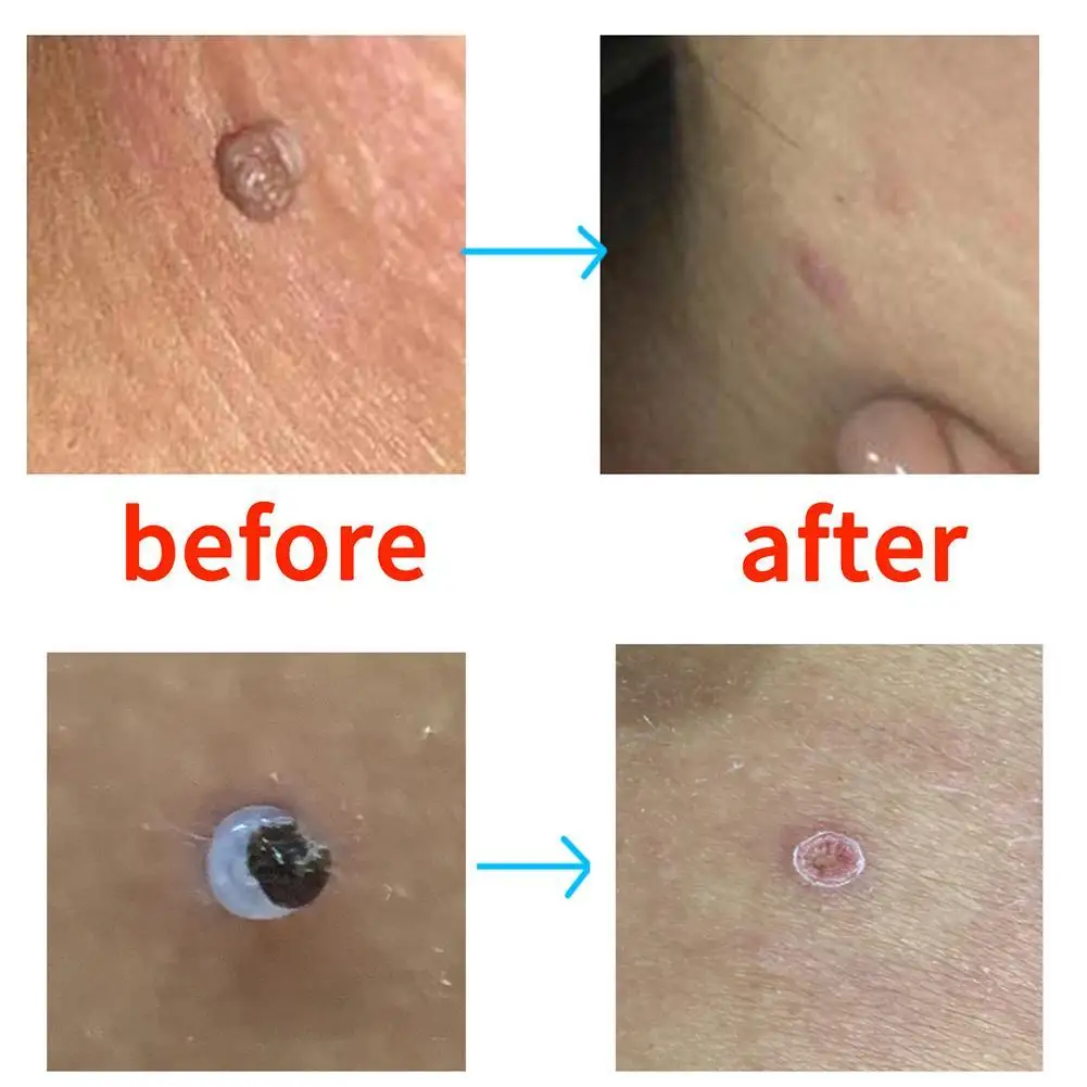 

Skin Tag Removal Kit Hot 1Set Home Use Mole Wart Remover Equipment Easy To Clean Care Micro Skin Tags Treatment Tool Rubber Ring