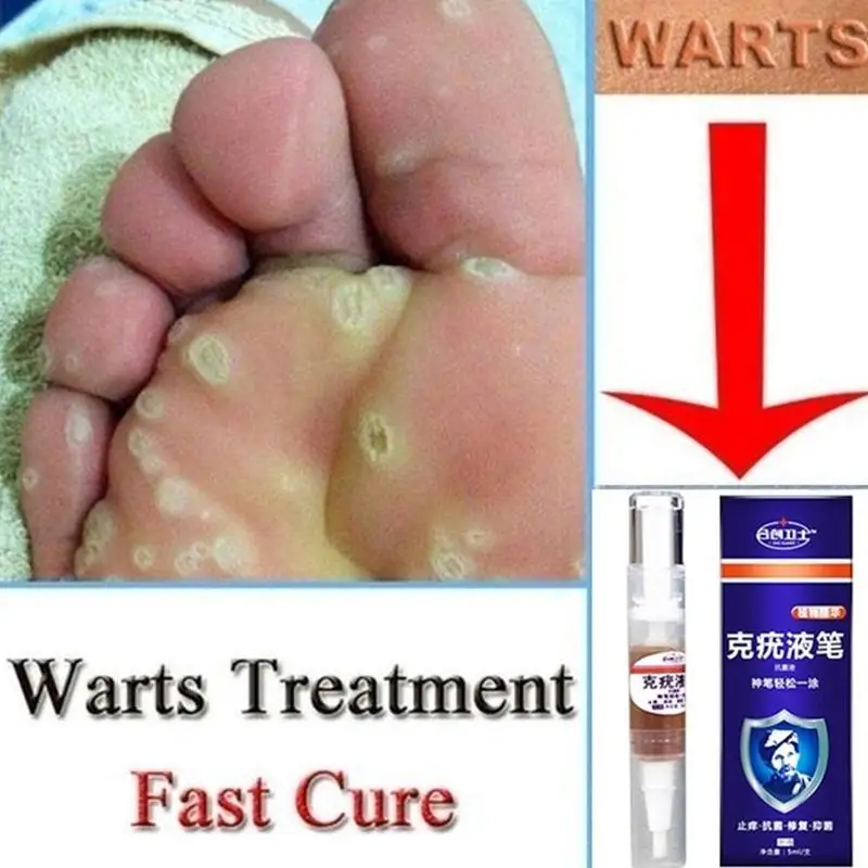 Средство для удаления мозолей на ногах сверхпрочное средство бородавок 12 часов 5