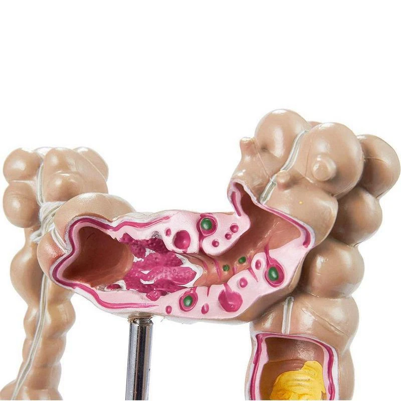 

Colorectal Lesion Model Human Colon Large Intestine Pathological Diseases Model Mrganizer Anatomy