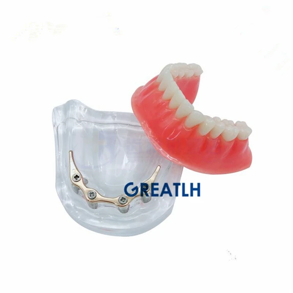 Overdenture implant model Denture Teeth mandibular with golden bar Dental Teaching Model | Красота и здоровье