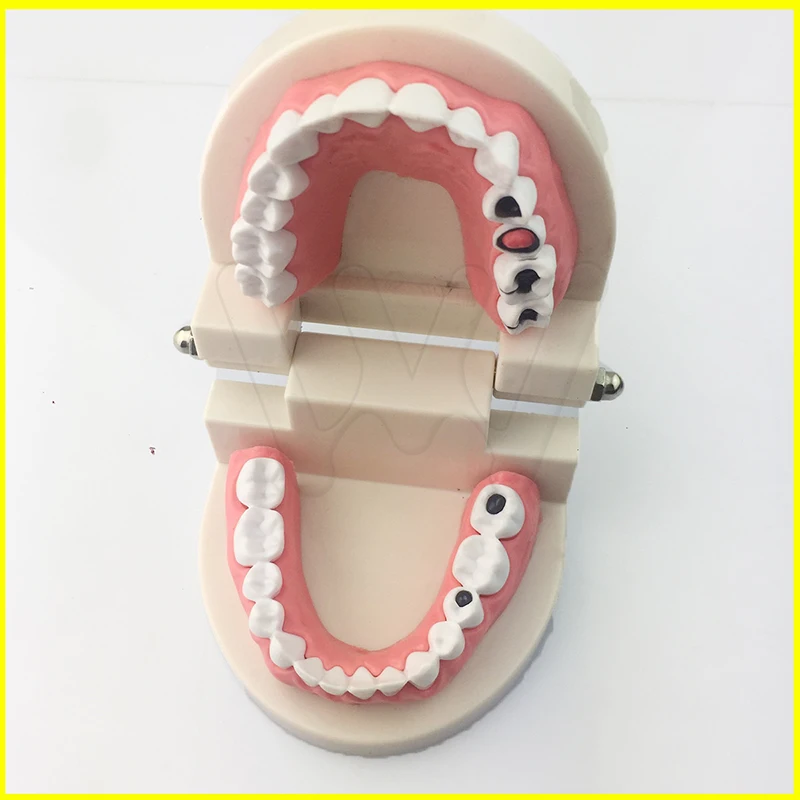 Стоматологическое обучение модель зубов кариес уход за зубами образование