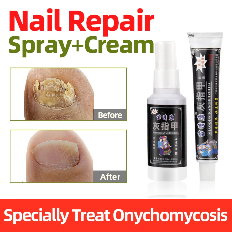 

Китайская травяная Антибактериальная жидкость для ногтей от грибков, онихомикоз, Лечебный крем для паринихии, восстанавливающая эссенция ...