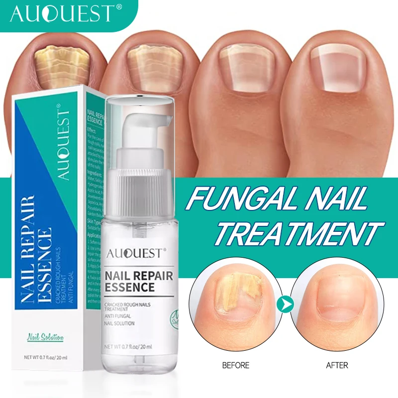 

Nail Fungus Treatment Fungus Remedy Serum Essence Anti Paronychia Onychomycosis Nail Fungus Removal Gel Foot Care 20ml