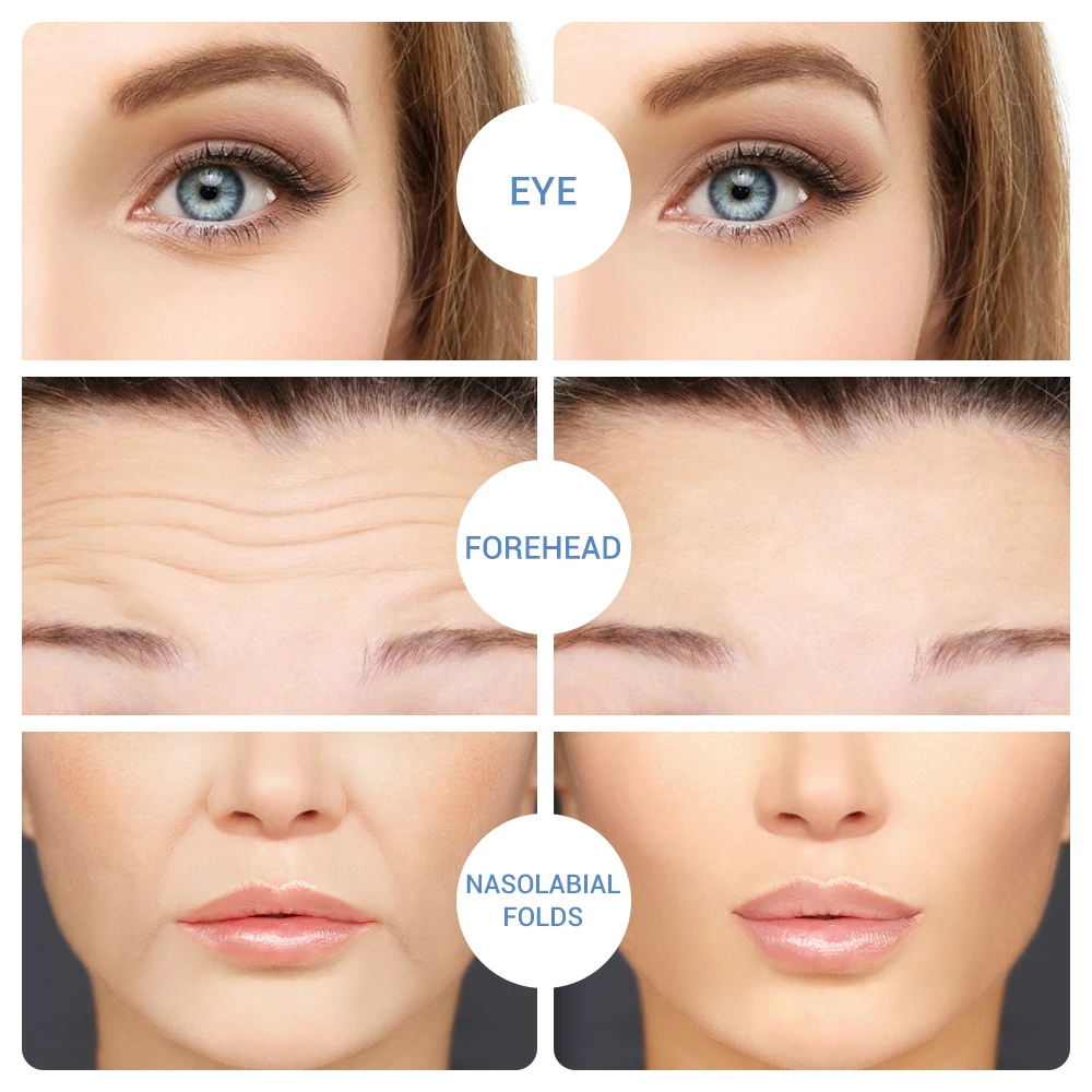Eye Patch Hyaluronic Acids Microneedle Eye Pads Whitening Moisturizing Wrinkles Fine Lines Dark Circles Removal Eye Mask