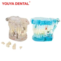 dental implant model dentistry dentist disease tooth implant model teeth with restoration bridge for medical science teaching