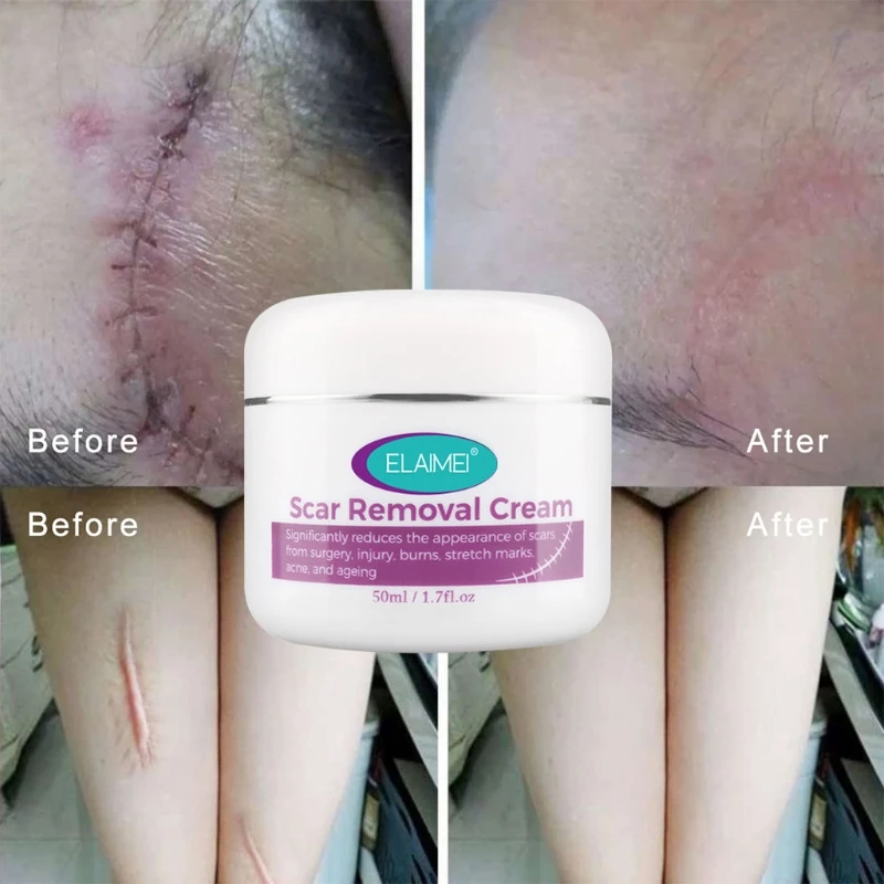

Scar Removal Cream Scars Treatment Skin Repair for Face Body Acne Spots 50ml