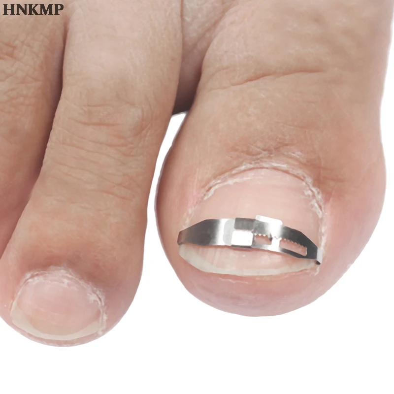 1 компл. Инструмент для лечения вросших ногтей инкрустированная Пряжка