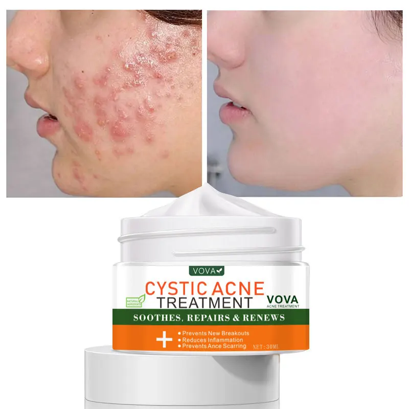

VOVA Cystic Acne Treatment Face Cream Refreshing Oil-Control Anti-Inflammatory Moisturizing Nourish Brighten Skin Beauty Product