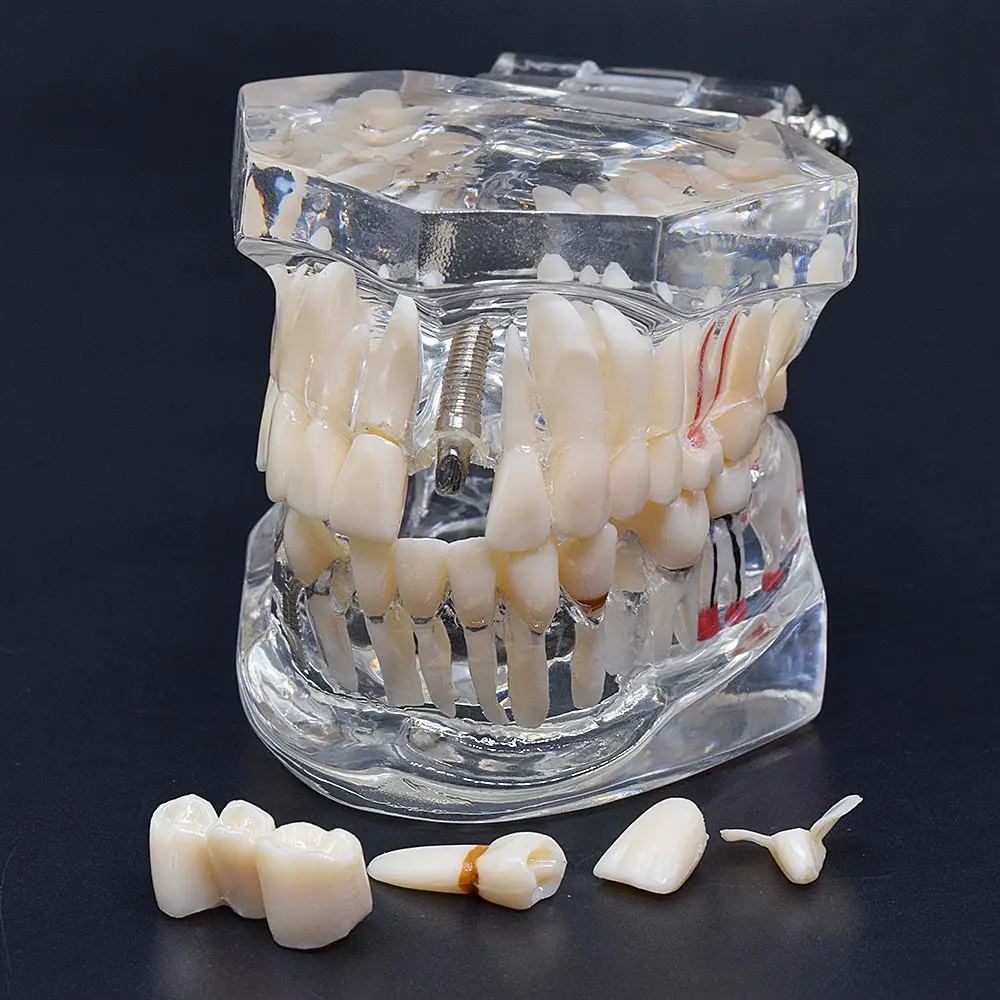 Модель зубного имплантата 1 шт. модель зубных протезов с реставрационным мостом