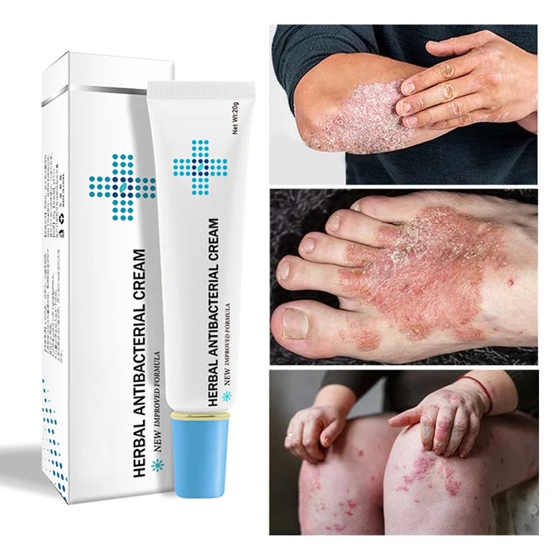 

Натуральная китайская медицина, травяной Антибактериальный крем, лечение псориаз экзема, травяной крем