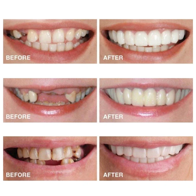 Силиконовая верхняя/нижняя вставка для зубов протезы инструменты гигиены