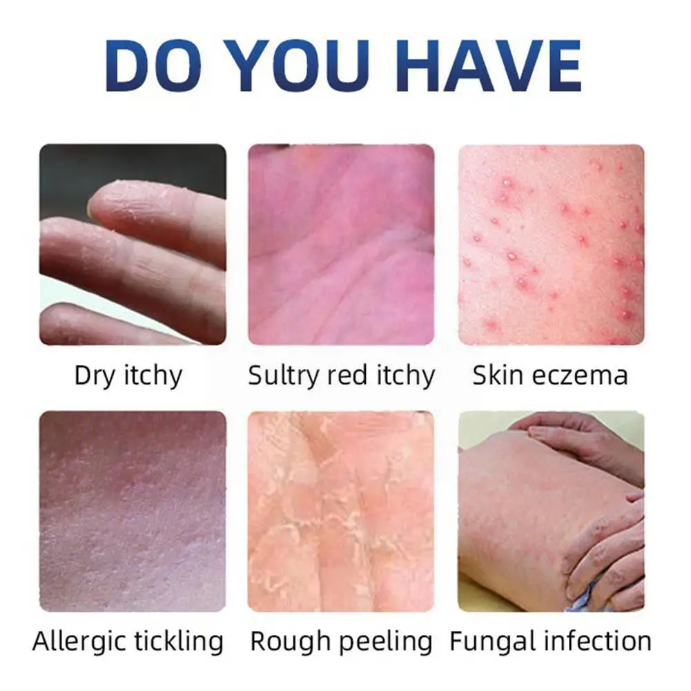 

20g Effective Antibacterial Cream Psoriasis Cream Ointment Eczema Dermatitis Ointment Cream Skin from Psoriasis Treatment C S8X9