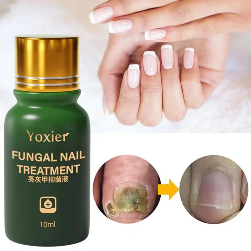 

10ml Nail Solution Effective Anti Infection Painless Nail Fungal Renewal Treatment Foot Care Foot Repair Serum Care