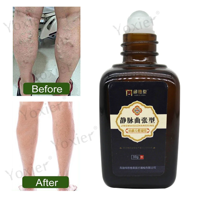 

Varicose Gel Serum Relieve Pain Leg Swelling Remove Earthworm Legs Swelling Of Blood Vessels Cold Compress Foot Skin Care 30g