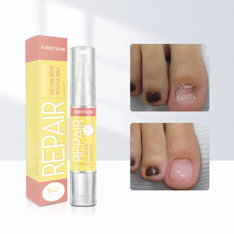 

Effective Nail Treatment Pen Onychomycosis Paronychia Anti Fungal Nail Infection Nutrition Chinese Herbal Toe Fungus Care Repair