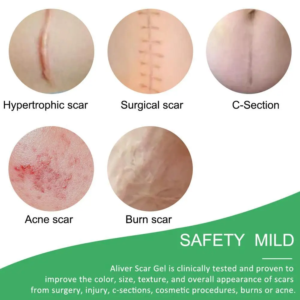 

4 Pieces Of Ultra-Thin Box Caesarean Section Surgery Repair Scar Stickers In Addition To Scar Stickers Scar Repair Stickers