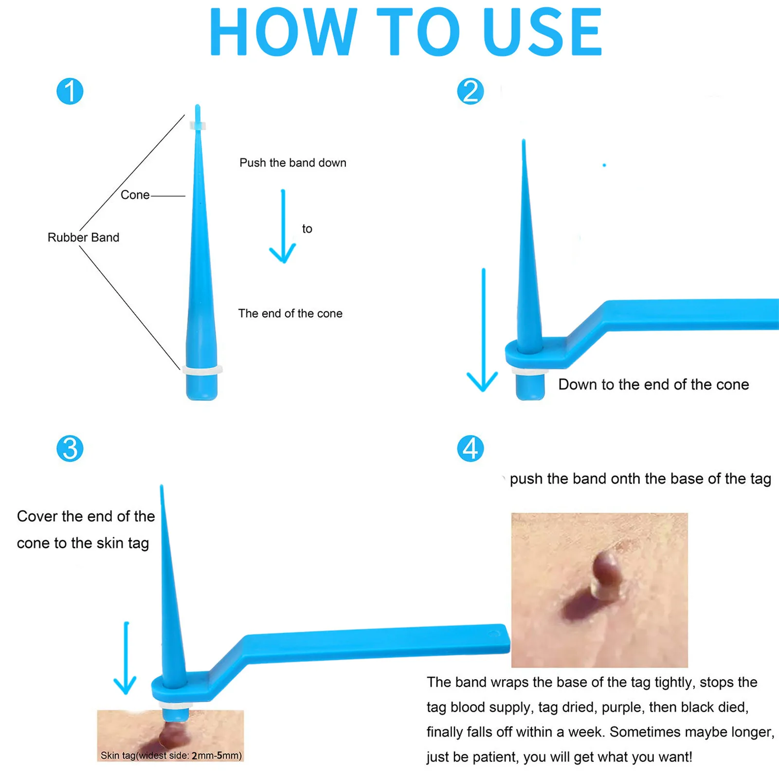 

Skin Tag Remover Skin Mole Wart Remover Effective Treatment Micro Skin With Cleansing Swabs Adult Mole Wart Face Care