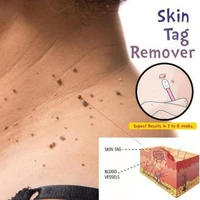 3ml liquid wart removal pen genital wart treatment fast removal mole genital wart foot corn skin tag remover foot care txtb1