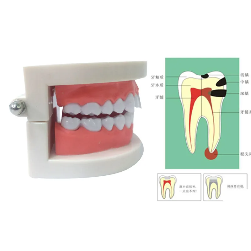 ABS PVC Dental Model Oral Instrument Tools Consumables Tooth Decay Medical Care Teaching Aids Teeth | Канцтовары для офиса и