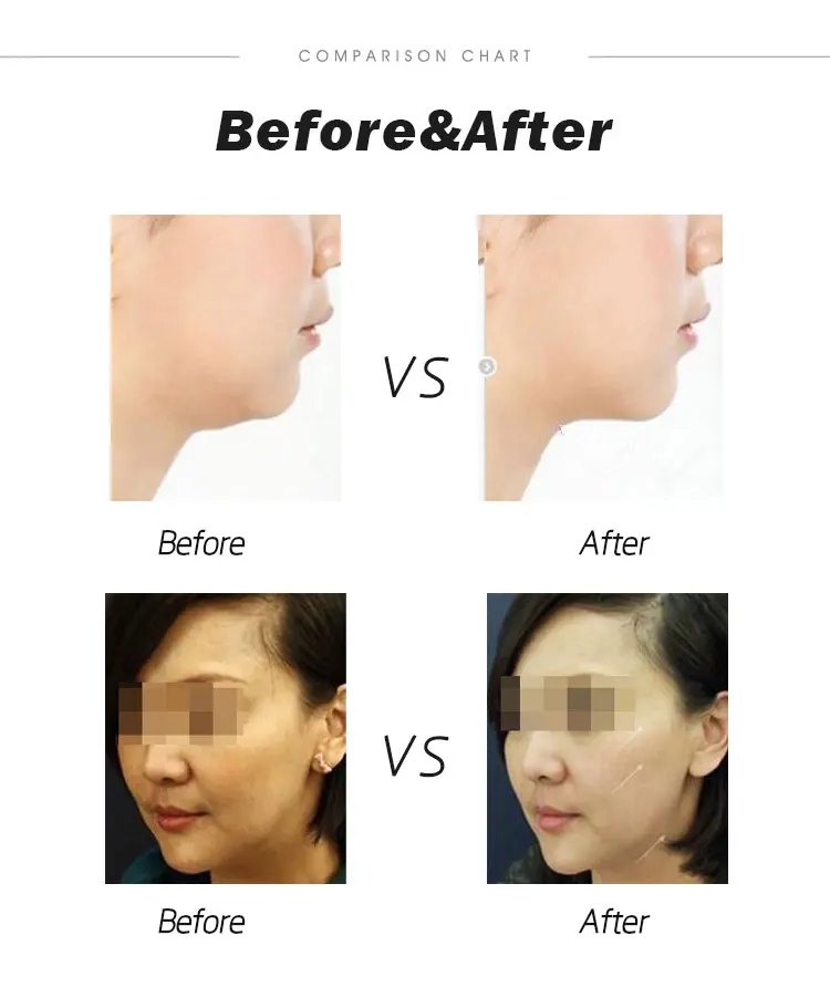 Ультразвуковой радар V для лица массаж вибрация подтяжка уход за кожей линии