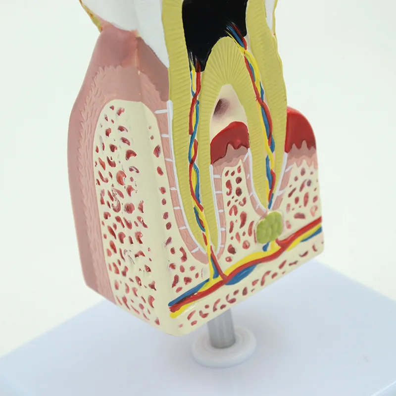 

Human large pathological tooth model dental caries model enlarged tooth anatomy
