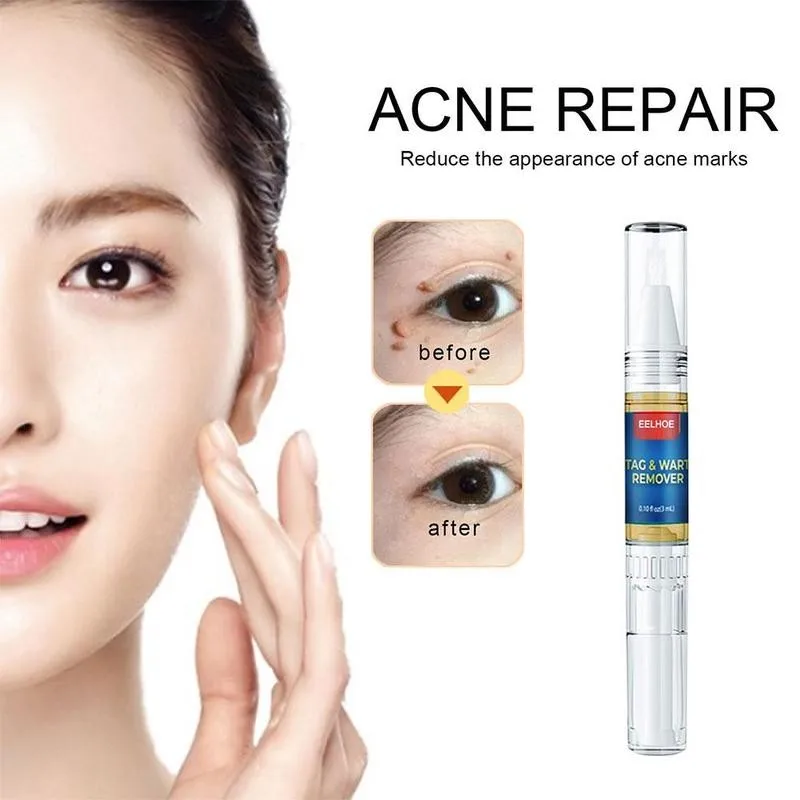 

11g Skin Beauty Mole Removal Pen 1pc Skin Tag & Wart Remover Pen Skin Tag Removal Skin Beauty Mole Removal Pen