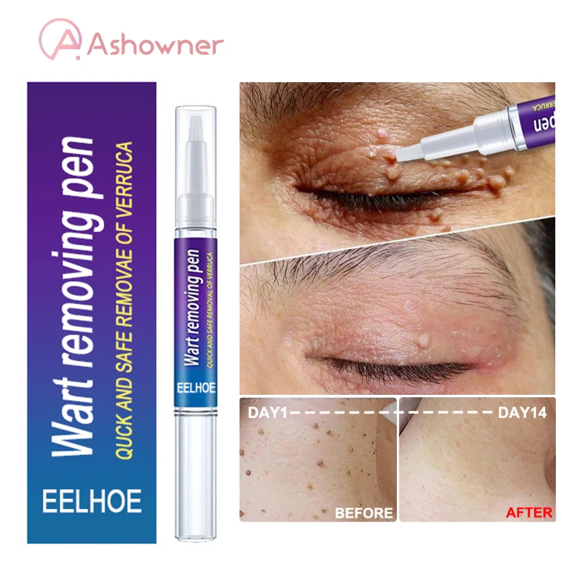 

Skin Tag Remover Pen Removal Genital Mole Wart Acne Spot Treatment Papillomas Anti Foot Corn Skin Care Natural Bacteriostatic