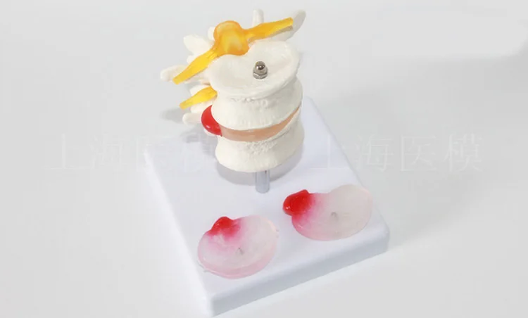 Две секции модели заболевания поясничного отдела дисков - грыжа поясничного межпозвонкового хребта.