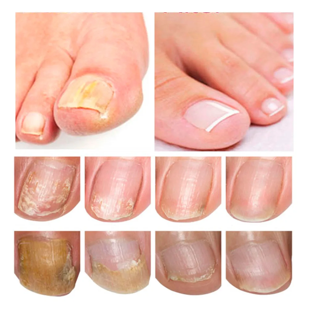 

Nail Repair Treatment Essence Serum Care Foot Whitening Toe Nail Fungus Removal Gel Anti Infection Paronychia Onychomycosis