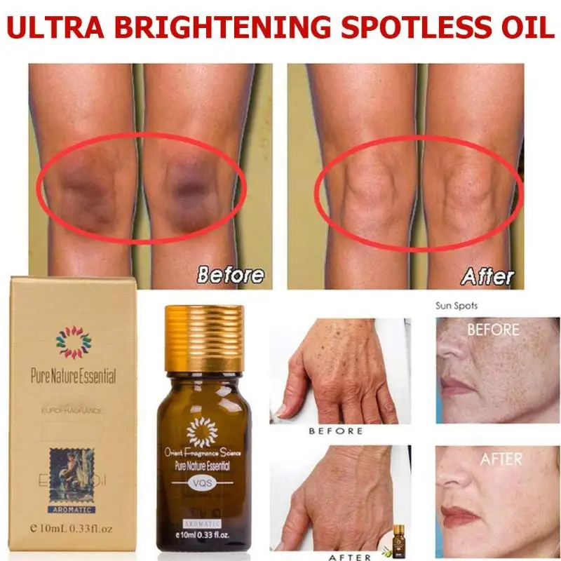 Масляная эссенция для удаления пятен и темных 10 мл/30 мл|Устройство ухода за кожей