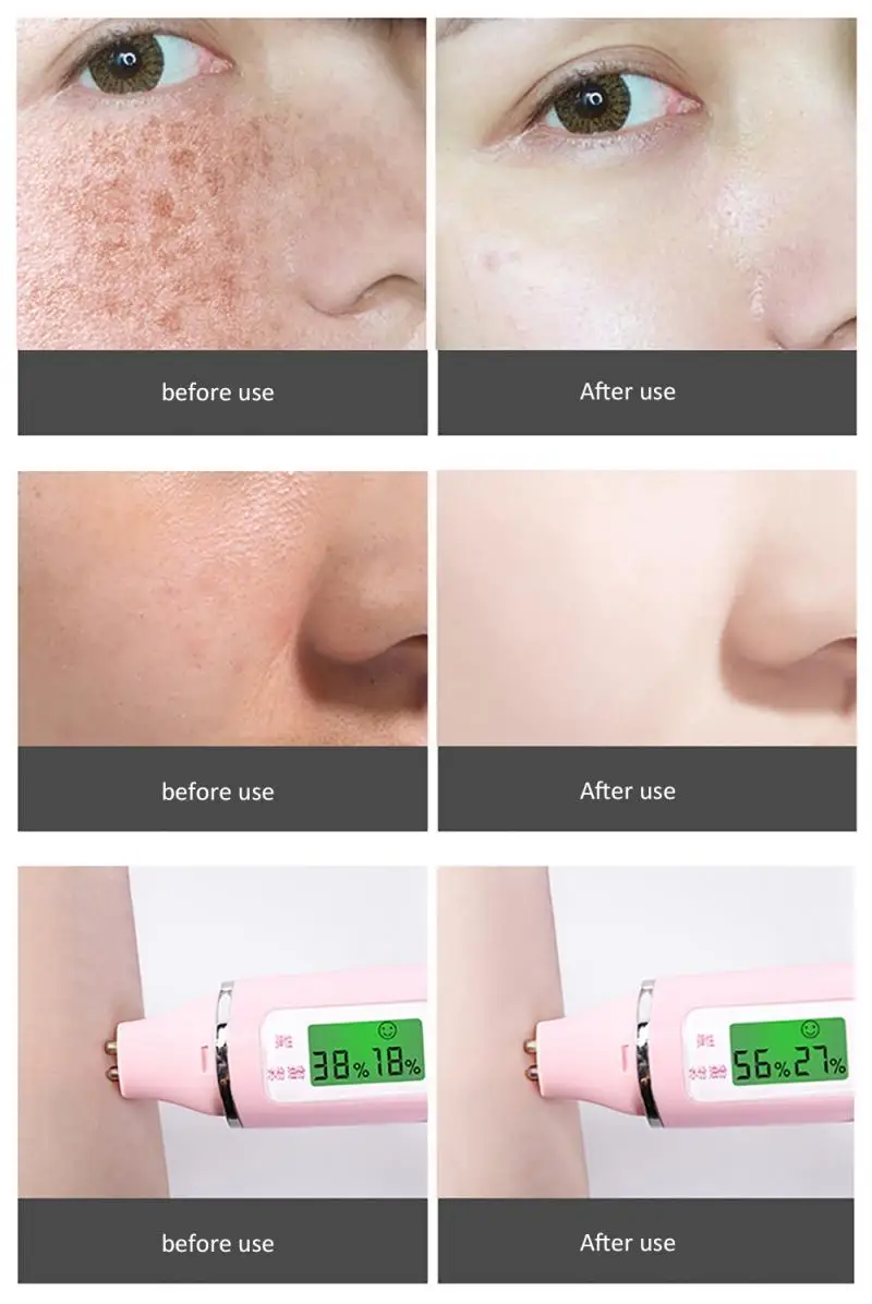 Сильные эффекты мощный дневной свет желтые пятсветильник крем от акне уход за