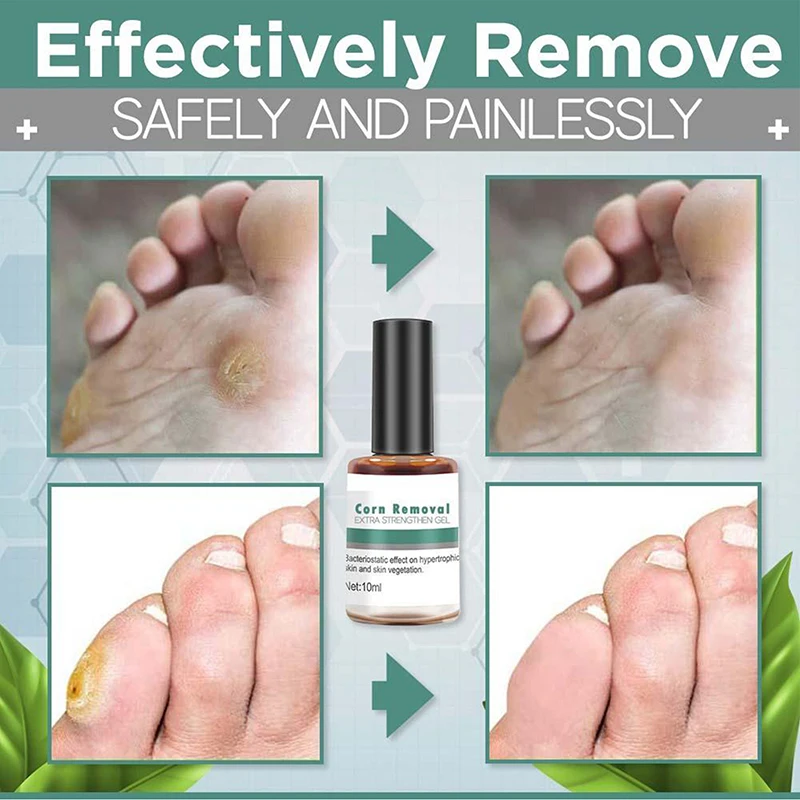 

Foot Care Corn Removal Extra Strengthen Gel Liquid To Smooth Skin Remove Warts White Corns Callosity Detox Foot Tag Remover