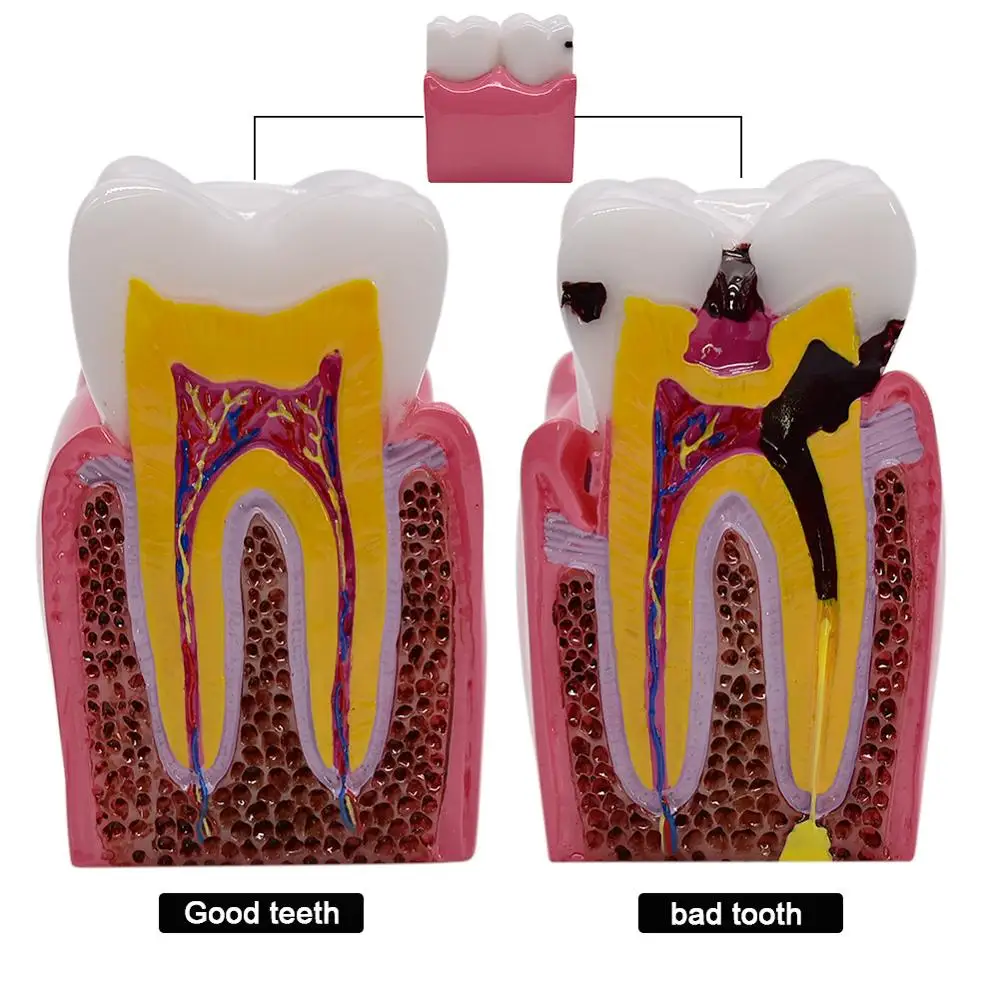 

1pc 6 Times Dental Caries Comparsion Models Tooth Decay Model For Dental Study Teaching Dental Anatomy Education Teeth Model