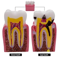 1pc 6 times dental caries comparsion models tooth decay model for dental study teaching dental anatomy education teeth model
