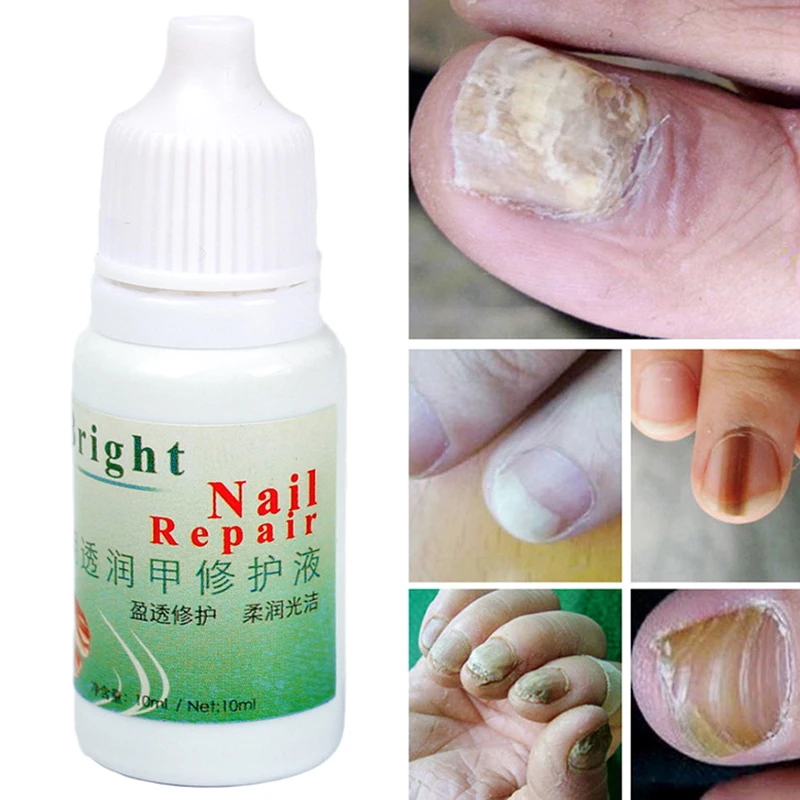 

10 мл грибковая эссенция для лечения ногтей Отбеливание ног удаление грибка для ногтей Уход за ногами Гель для ногтей онихомикоз