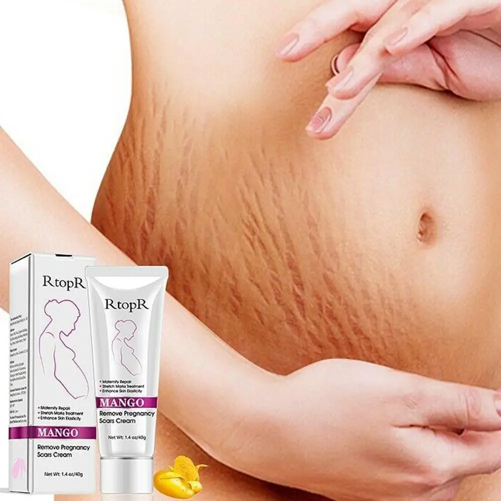 

Natural Mild Non-irritating Mango Stretch Mark Pregnancy Cream Slack care Cream Scar Stretch Line Repair skin Marks Abdomen E0W2