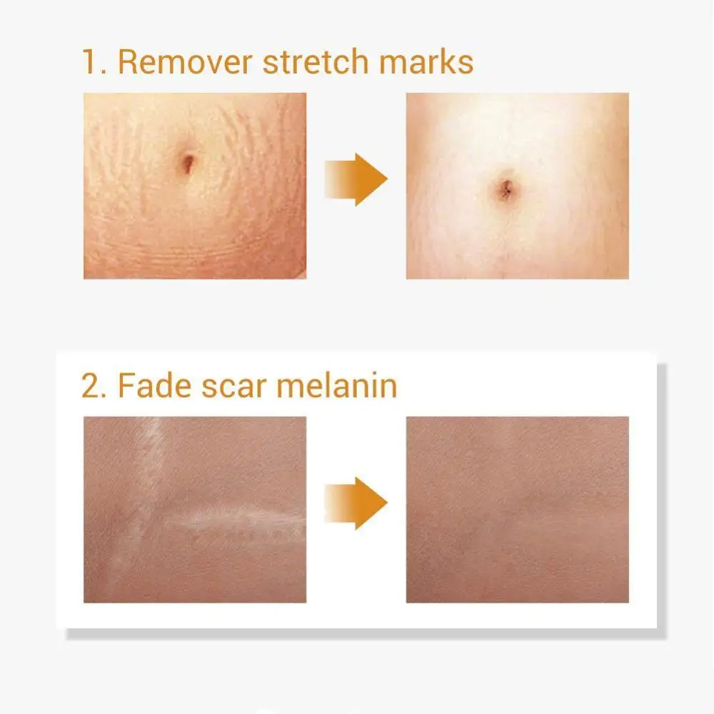 LANBENA растяжки удаляет рубцы после акне сыворотка для лечения уменьшает поры