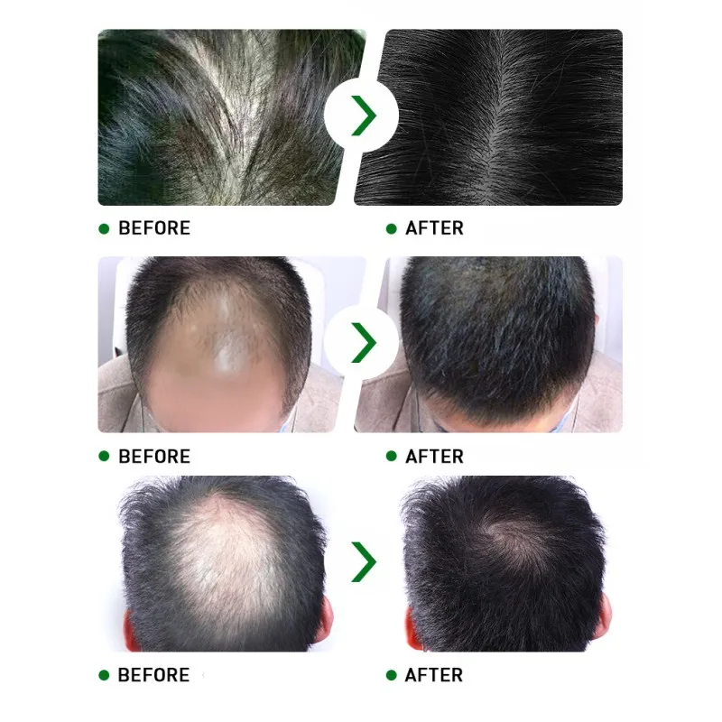 Юньнань против выпадения волос эссенция 30 мл травяные волосы для роста жидкость