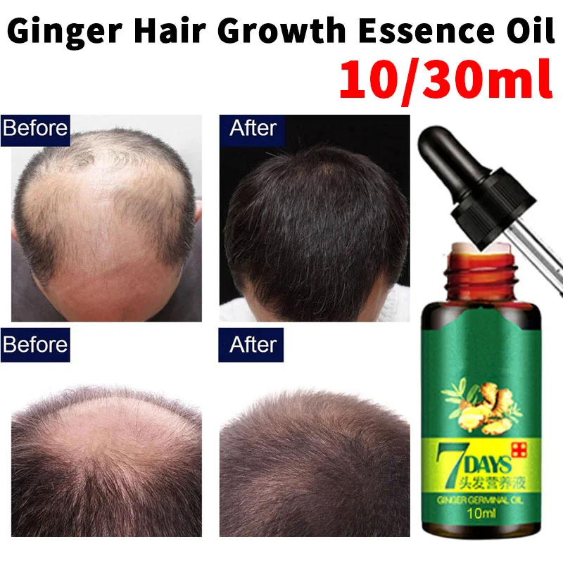 

10ml Ginger Hair Growth Essence Oil Hair Loss Treatment Serum For Thicker Healthier Hair Men Women Repair Damaged Hair hot sale