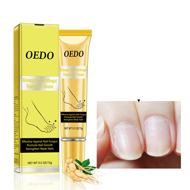 

Травяное средство для лечения Ногтей От женьшеня, крем для удаления грибка ногтей, против инфекции, паронихия, онихомикоз, крем для ухода за ...