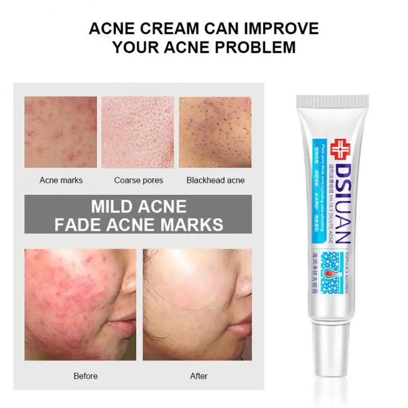 

Whitening Freckle Cream Moisturizing Remove Melasma Cream Shrink Pore Fade Spots Acne Cream Brighten Skin Care Lightening TSLM2
