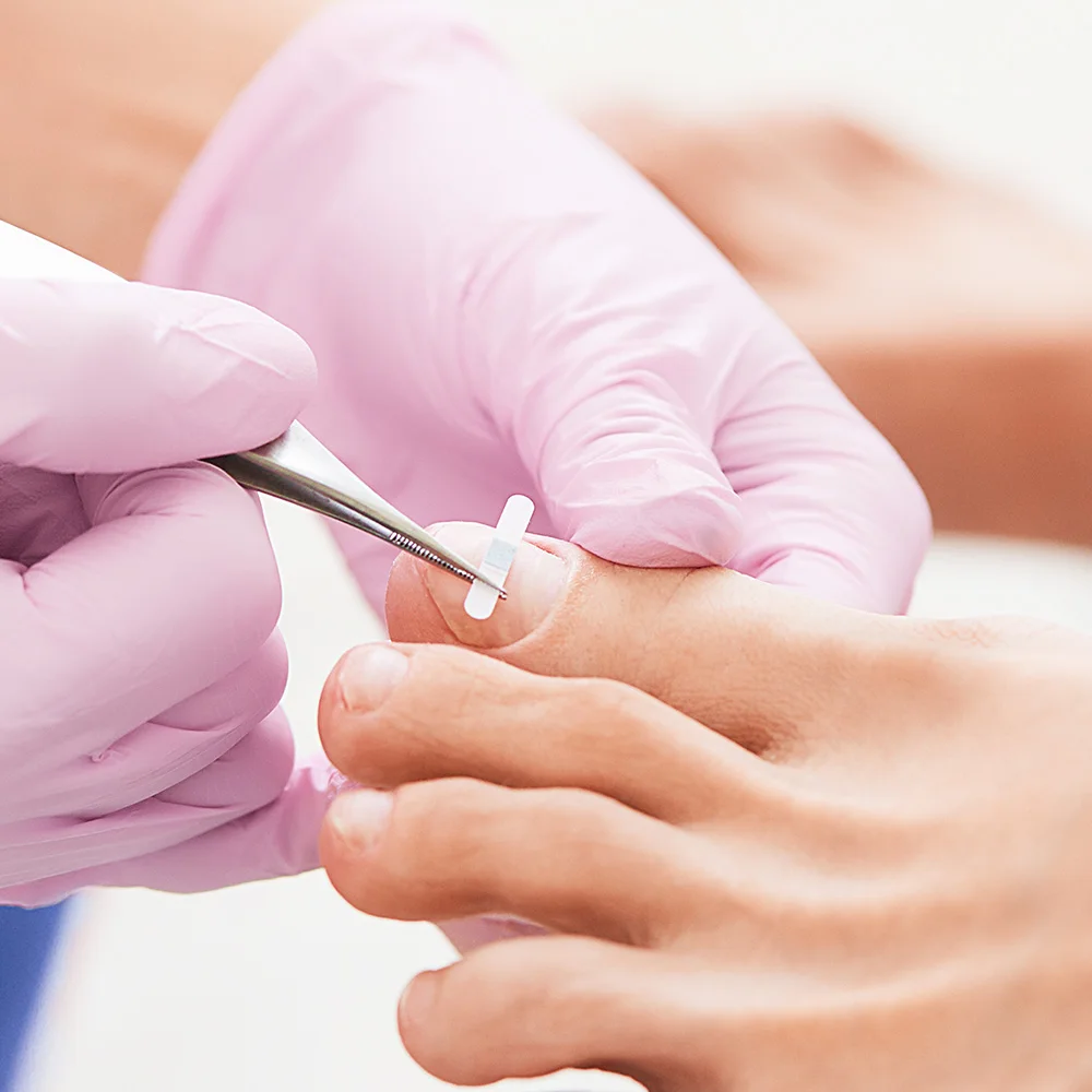 Инструменты для коррекции вросших пальцев пилочка ногтей набор выпрямления и